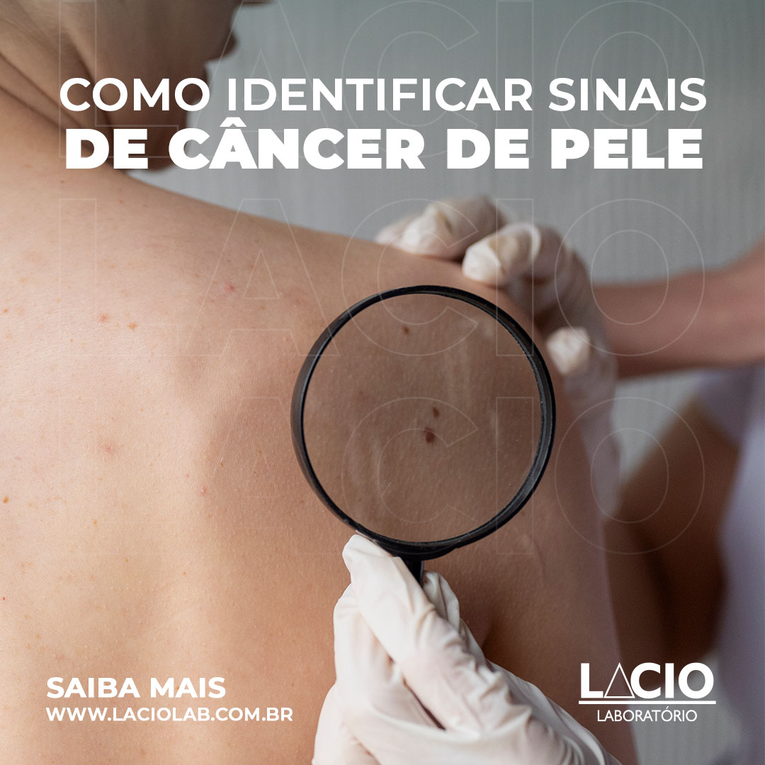 Como você pode identificar os sinais precoces do câncer de pele?